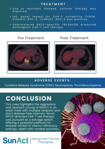 SunAct | Advanced Cancer Therapies in India